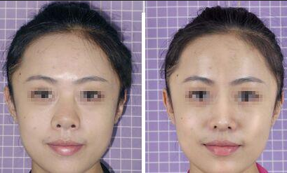 膨體隆鼻后遺癥的出現(xiàn)有哪些？危害大嗎？