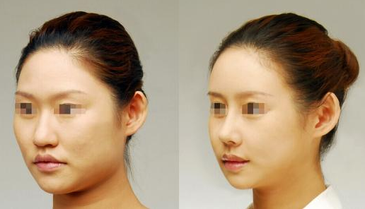 膨體隆鼻可以*嗎？有哪些注意事項？