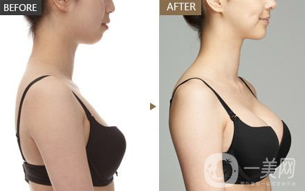 隆胸有幾種方法 哪種方法比較好？