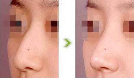 駝峰鼻有哪些類型？駝峰鼻矯正方法全解