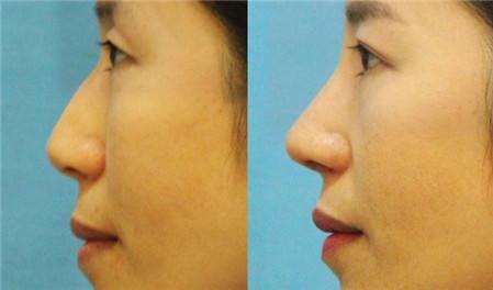 駝峰鼻整形術(shù)后注意事項(xiàng)有哪些？