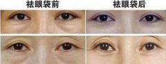 廣東內(nèi)切祛眼袋價格是多少