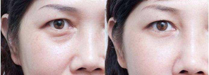 深圳內(nèi)切祛眼袋手術價格