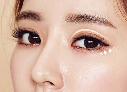 北京雙眼皮埋線價格