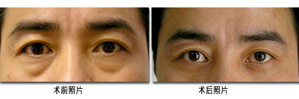 北京內(nèi)切祛眼袋多少錢