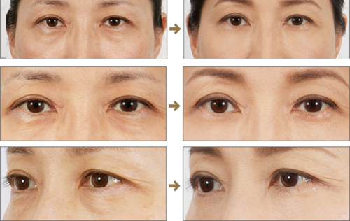 北京內(nèi)切祛眼袋多少錢