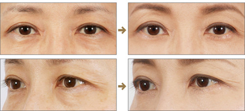 上海激光祛眼袋價格是多少