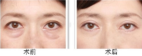 上海激光祛眼袋價格是多少