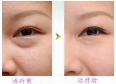 廣東手術(shù)祛眼袋價格