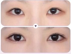 深圳眼部手術(shù)整形價格是多少