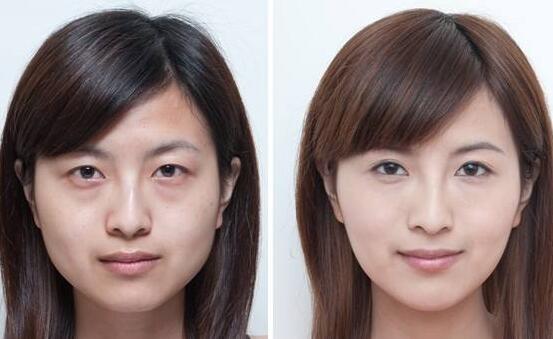 深圳超聲波祛眼袋價(jià)格