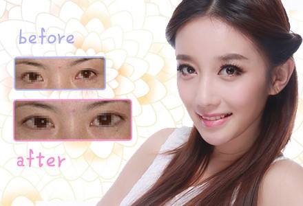 深圳,開外眼角,多少錢