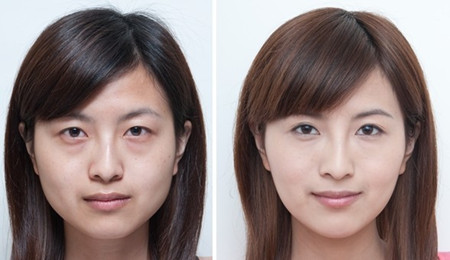 北京去黑眼圈多少錢