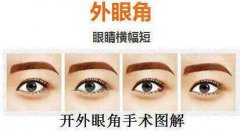 深圳開內眼角價格是多少