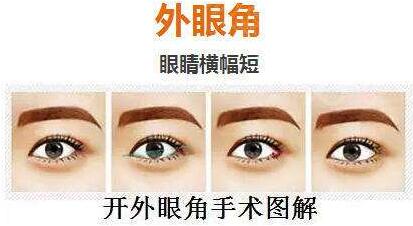 深圳開內(nèi)眼角價格是多少