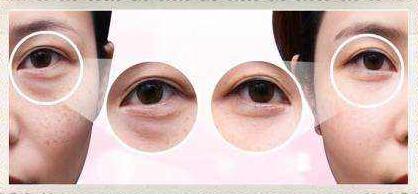 上海激光去黑眼圈價格