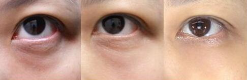 上海激光去黑眼圈價格