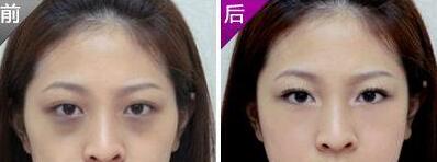 深圳激光去黑眼圈需要多少錢(qián)