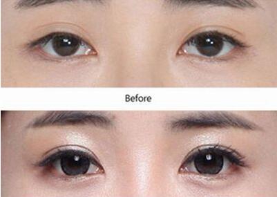 廣東眼部整形失敗修復手術(shù)費用