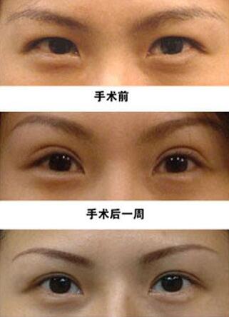 深圳眼皮抽脂手術(shù)多少錢