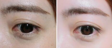 廣東,玻尿酸去黑眼圈,多少錢(qián)