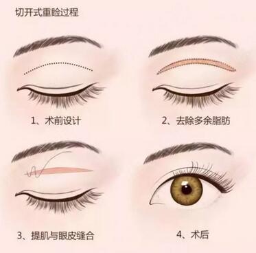 北京上眼瞼去脂多少錢