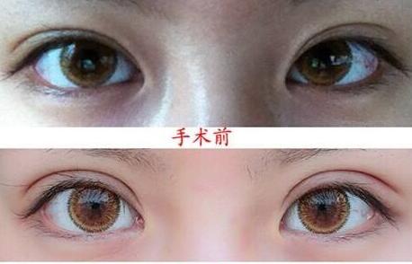 上海,眼瞼整形,手術(shù)費用