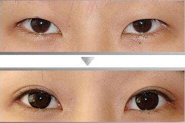 廣東,眼瞼整形,價(jià)格