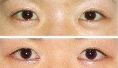 深圳,眼瞼整形,多少錢(qián)