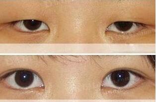 北京,上瞼提肌,多少錢