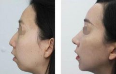 駝峰鼻多少錢 駝峰鼻矯正費(fèi)用盤點(diǎn)