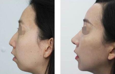 駝峰鼻多少錢(qián)