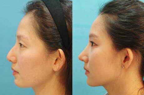 駝峰鼻多少錢(qián)