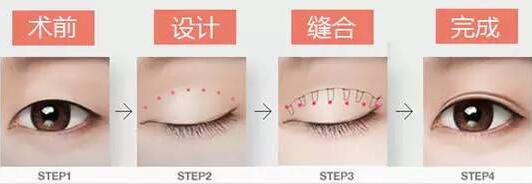 焊接雙眼皮是什么？有哪些特點(diǎn)？