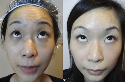 抬頭紋怎么調(diào)節(jié)