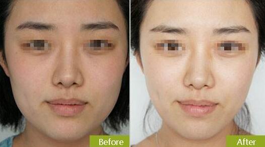 等離子激光溶脂價格是多少