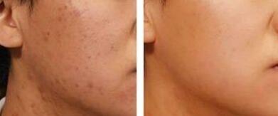 像素激光去痘坑*果怎么樣