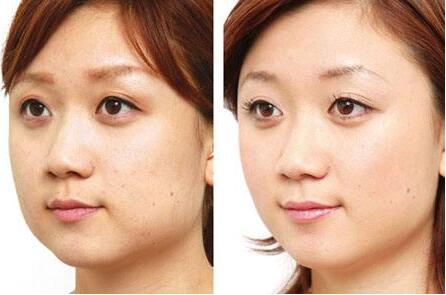 去頰脂墊價格是多少？貴不貴？