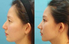 駝峰鼻矯正的調(diào)節(jié)費用