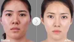 朝天鼻整容多少錢？