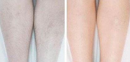 怎樣去除腿毛、*果怎么樣