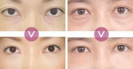 超聲波去眼袋價(jià)格、*果能保持多久
