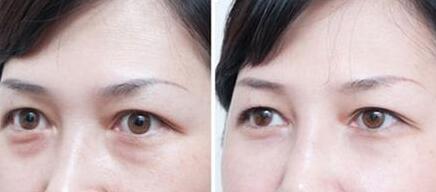 超聲波去眼袋價(jià)格、*果能保持多久