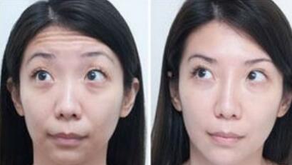 用什么方法能去皺、除皺多少錢