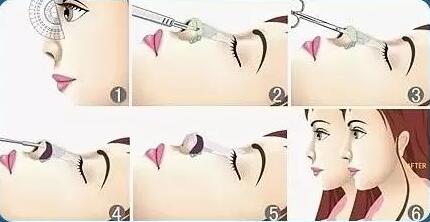 硅膠隆鼻費用是多少？貴嗎？