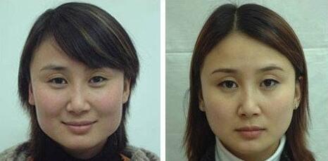 顴骨顴弓,整形,風險,注意事項