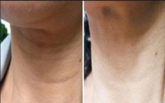 頸紋怎么消除*？那種方法好？