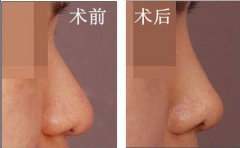 自體軟骨隆鼻是*的嗎？有哪些優(yōu)勢？