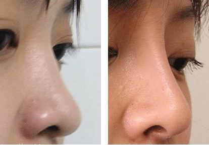 隆鼻后多久山根會自然？*果能保持多久？