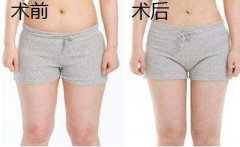 大腿吸脂有幾個(gè)切口？大腿環(huán)吸幾個(gè)切口？